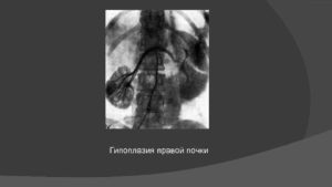 Дистопия и гипоплазия почки плода