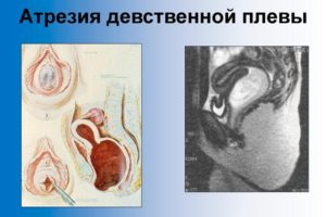 Растянут ли гимен