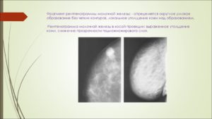 Узловое образование в молочной железе