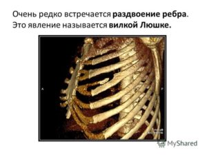 Ребро Люшко
