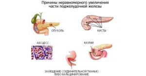 Увеличение хвоста поджелудочной железы
