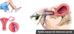 Про аспират из матки