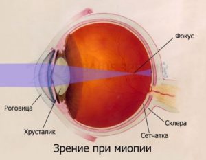 Миопия высокой степени и роды