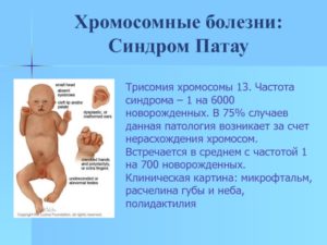 ЭКО, дважды выявлена трисомия 13 хромосомы
