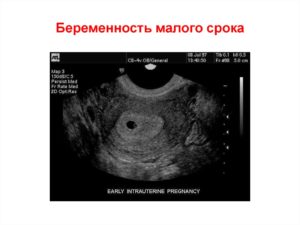 Беременность малого срока