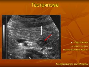 Образование в хвосте поджелудочной железы