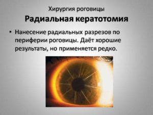 Замена хрусталика после радиальной кератотомии с рефракционной целью
