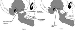 Растяжение связок челюстного сустава