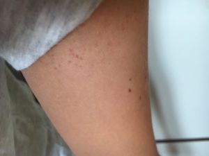 Сыпь под грудью, подмышками, в локтевых сгибах и на бедрах