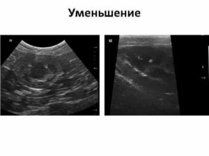 Почки уменьшились по результатам УЗИ