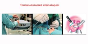 Удаление миндалин коблатором