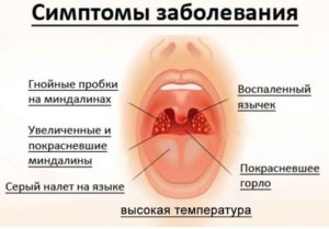 Золотистый стафилококк и хронический тонзиллит