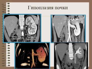 Дистопия и гипоплазия почки плода