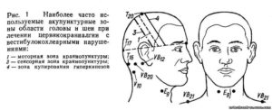 Онемение правой стороны лица и руки