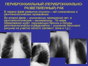 Перибронхиальные изменения