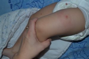 Шишечка после прививки (вакцина пентаксим)