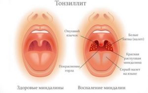 Золотистый стафилококк и хронический тонзиллит