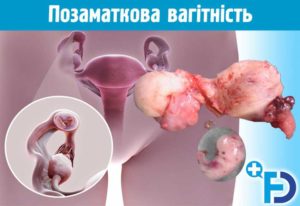 Возможна беременность если идут месячные