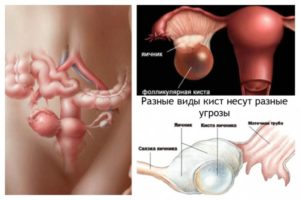 Киста яичника можно ли заниматься сексом
