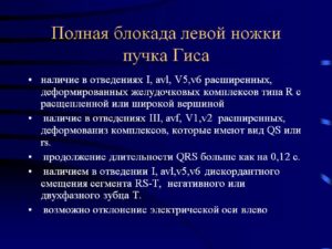 Полная блокада левой ножки пучка гиса