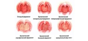 Хронический фарингит. Бактериальный или вирусный?
