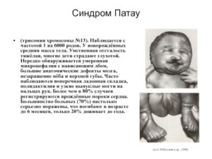 ЭКО, дважды выявлена трисомия 13 хромосомы