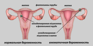 Возможна беременность если идут месячные