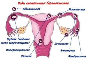 Возможна беременность если идут месячные